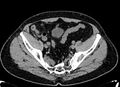 Acute appendicitis (Radiopaedia 13030-13091 Axial non-contrast 68).jpg