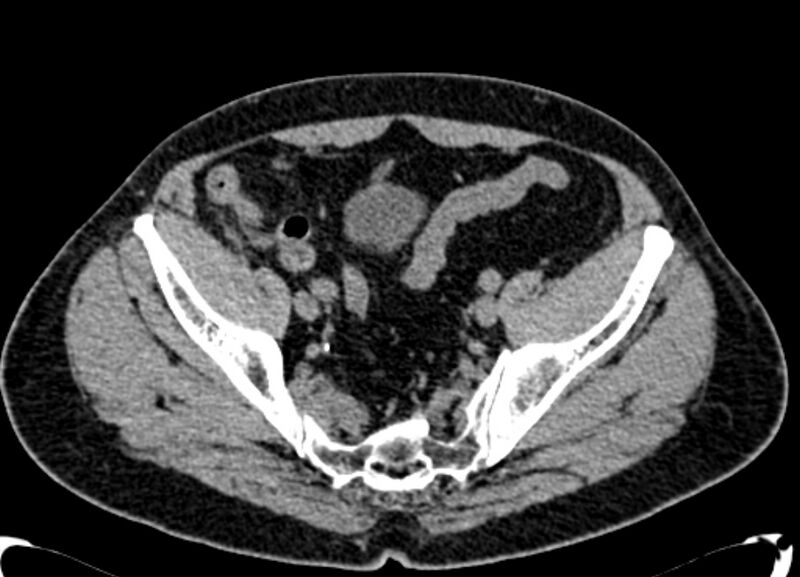 File:Acute appendicitis (Radiopaedia 13030-13091 Axial non-contrast 68).jpg