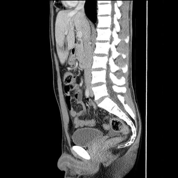 File:Acute appendicitis (Radiopaedia 27049-27227 Sagittal C+ portal venous phase 38).jpg