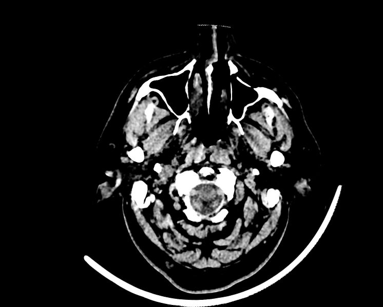 File:Acute cerebral infarct (Radiopaedia 35604-37123 Axial non-contrast 4).jpg