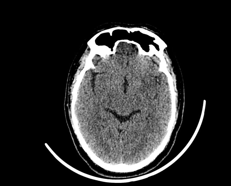 File:Acute cerebral infarct (Radiopaedia 35604-37123 Axial non-contrast 44).jpg