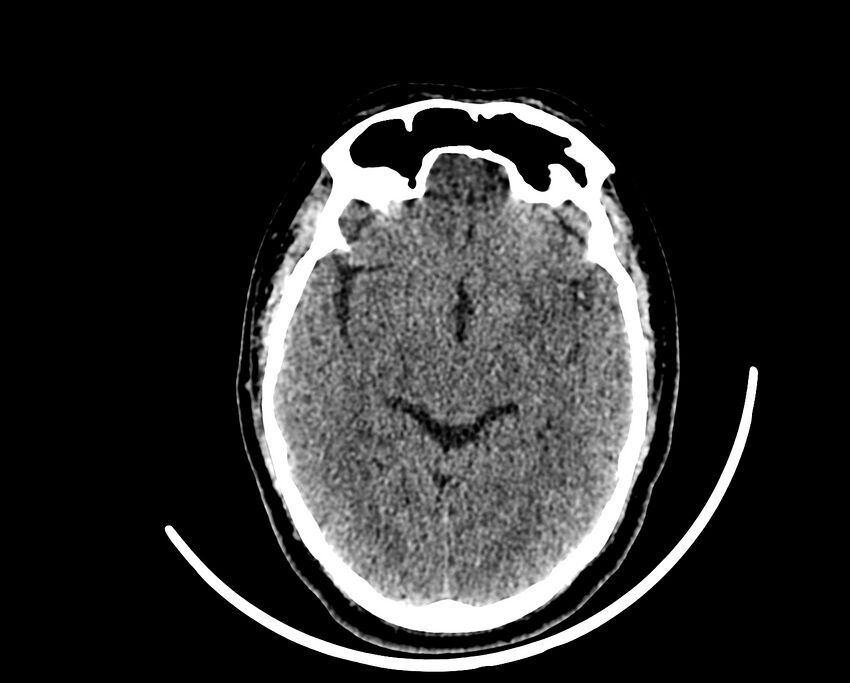 Acute cerebral infarct (Radiopaedia 35604-37123 Axial non-contrast 44).jpg