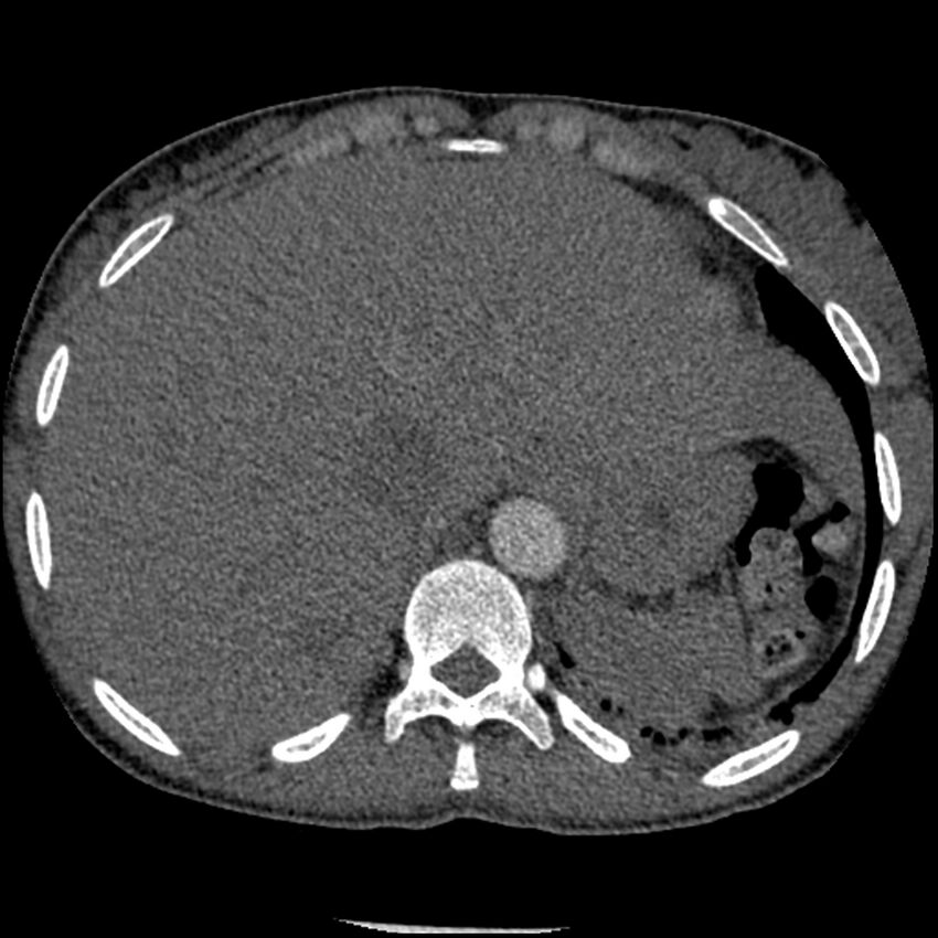 Acute chest syndrome - sickle cell disease (Radiopaedia 42375-45499 Axial C+ CTPA 170).jpg
