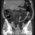 Acute cholecystitis and ureteric colic (Radiopaedia 42330-45444 Coronal prone 47).jpg