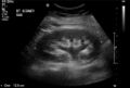 Acute cholecystitis and ureteric colic (Radiopaedia 42330-45445 Longitudinal 1).jpg