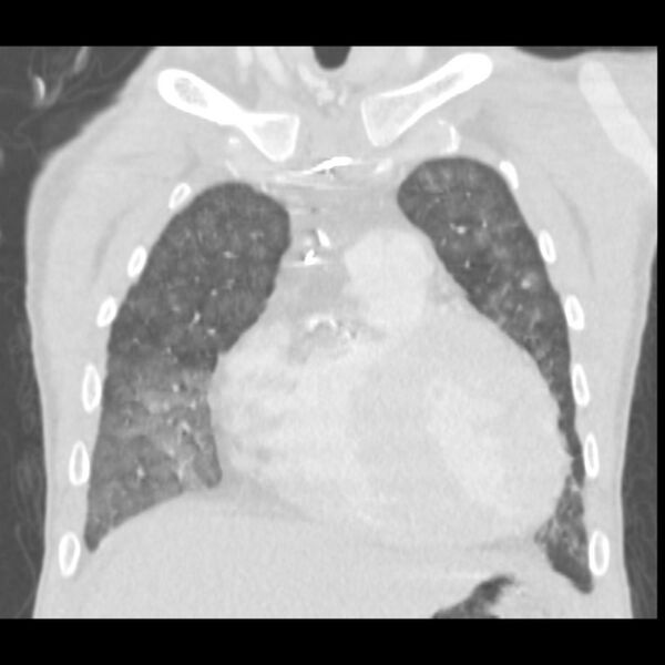 File:Acute diffuse alveolar hemorrhage (Radiopaedia 41323-44158 Coronal lung window 10).jpg