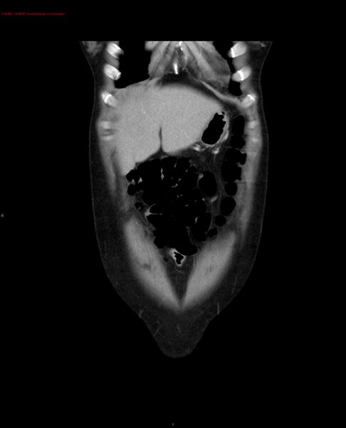 File:Acute gastritis (Radiopaedia 21043-20975 Coronal C+ portal venous phase 26).jpg