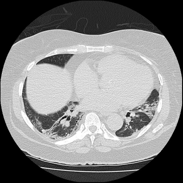 File:Acute interstitial pneumonitis (Radiopaedia 45404-49452 Axial lung window 60).jpg