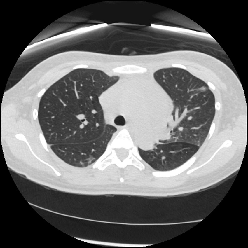 Acute lupus nephritis (Radiopaedia 45832-50107 Axial lung window 30).jpg