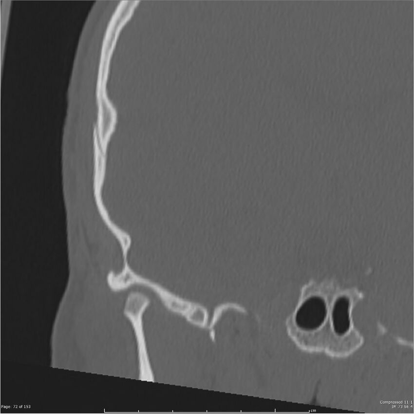 Acute otomastoiditis (Radiopaedia 28276-28512 Coronal PTB bone window reformat 3).jpg