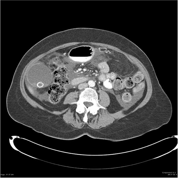 File:Acute pancreatitis (Radiopaedia 19136-19117 Axial C+ portal venous phase 24).jpg