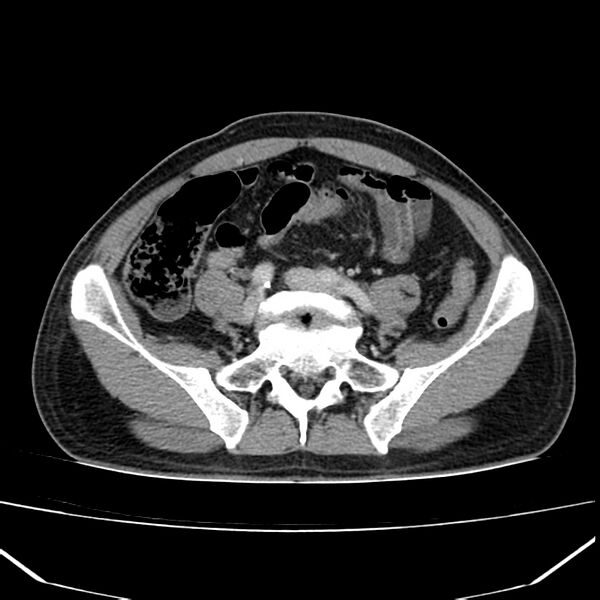 File:Acute pancreatitis (Radiopaedia 22572-22596 Axial C+ portal venous phase 52).jpg