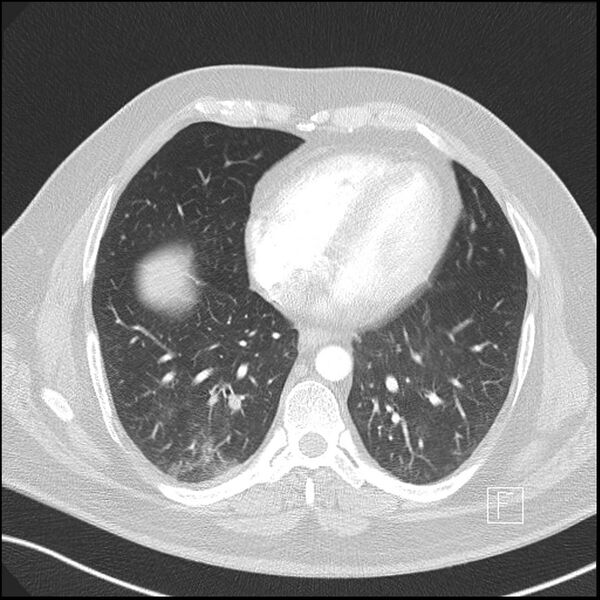 File:Acute pulmonary embolism with pulmonary infarct (Radiopaedia 73062-83768 Axial lung window 9).jpg