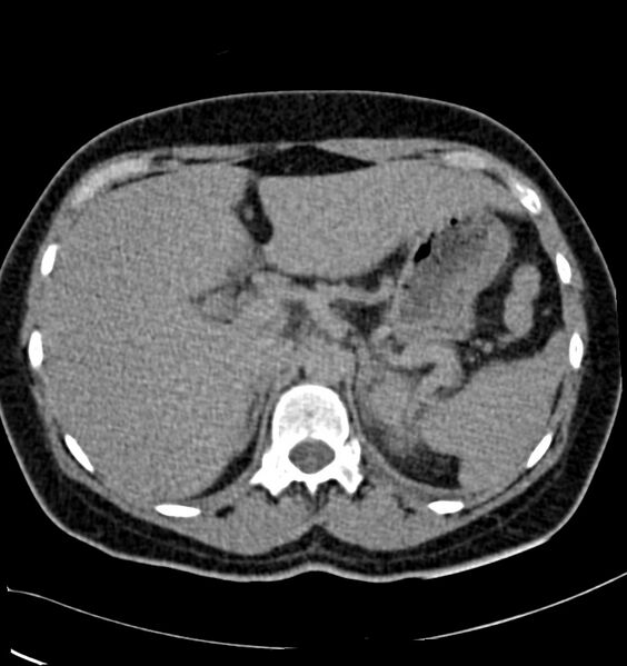 File:Acute pyelonephritis (Radiopaedia 40264-42816 Axial renal excretory phase 1).jpg