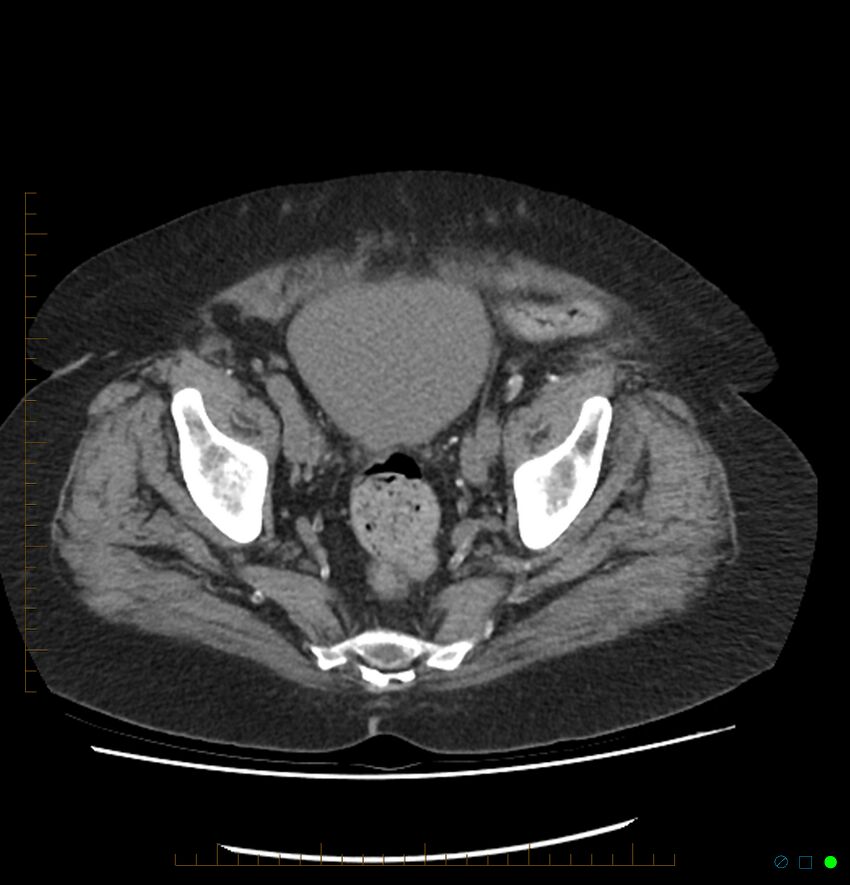 Acute renal failure post IV contrast injection- CT findings (Radiopaedia 47815-52557 Axial non-contrast 69).jpg