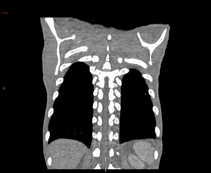 File:Acute right lung abscess (Radiopaedia 34806-36258 Coronal C+ arterial phase 5).jpg