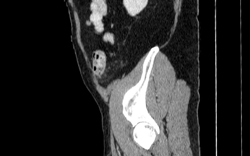 File:Acute sigmoid colon diverticulitis (Radiopaedia 55507-61976 Sagittal C+ portal venous phase 113).jpg