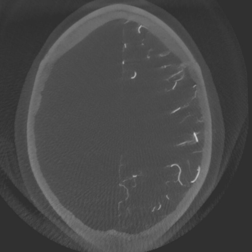 Acute subarachnoid hemorrhage and accessory anterior cerebral artery (Radiopaedia 69231-79010 C 53).jpg