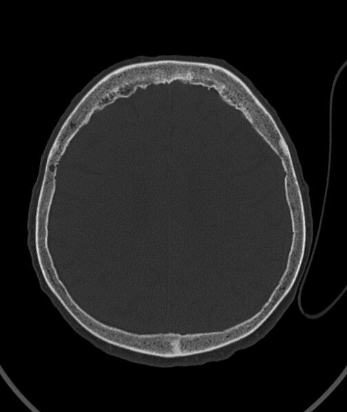 File:Acute traumatic subdural hematoma (Radiopaedia 82921-97257 Axial bone window 39).jpg