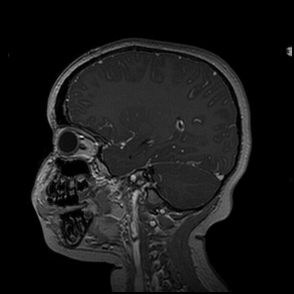 File:Adamantinomatous craniopharyngioma (Radiopaedia 77407-89529 H 80).jpg