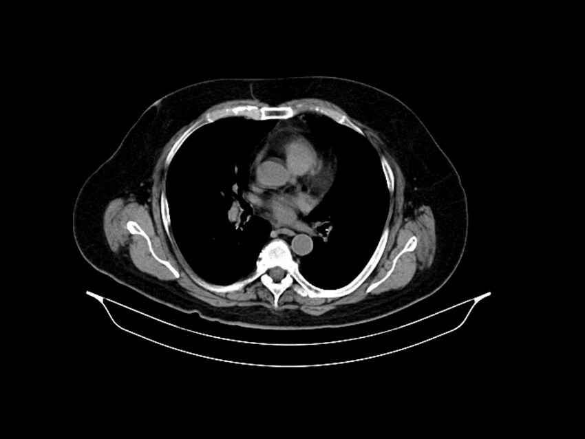 Adenocarcinoma of pancreas with hepatic metastasis (Radiopaedia 64332-73122 Axial non-contrast 5).jpg