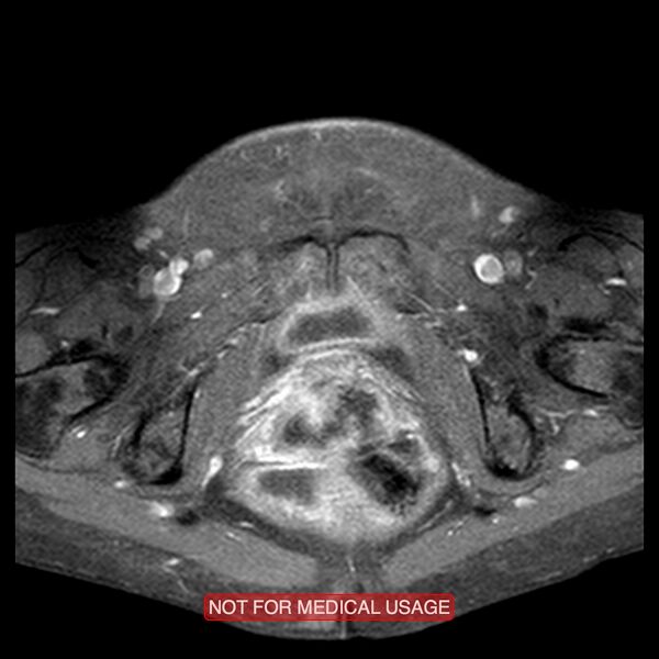 File:Adenocarcinoma of the cervix (Radiopaedia 28373-28615 Axial T1 C+ fat sat 4).jpg