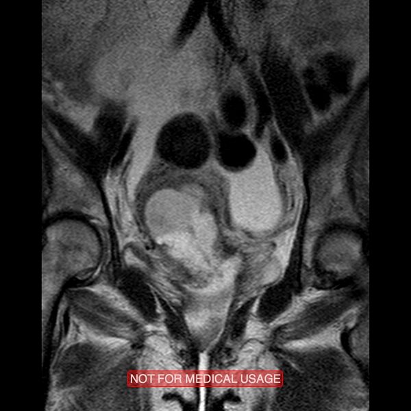 File:Adenocarcinoma of the cervix (Radiopaedia 28373-28615 Coronal T2 10).jpg