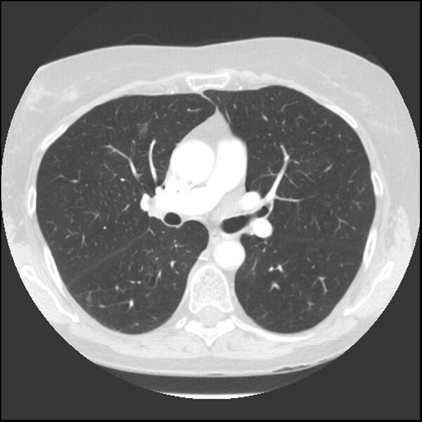 File:Adenocarcinoma of the lung (Radiopaedia 41015-43755 Axial lung window 54).jpg