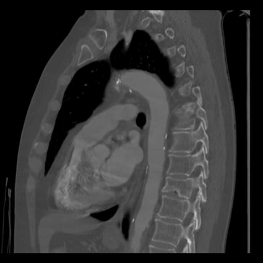 Adenocarcinoma of the lung (Radiopaedia 41015-43755 Sagittal bone window 60).jpg