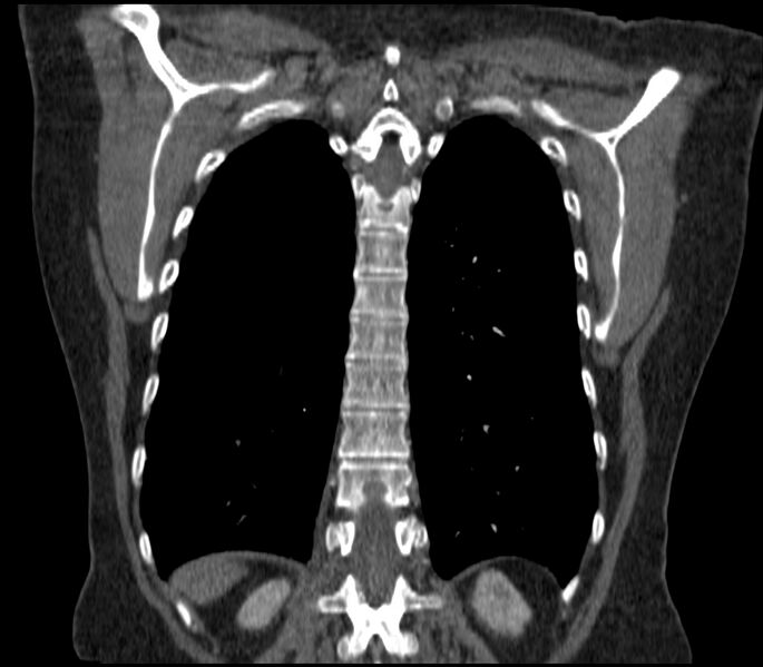 File:Adenocarcinoma of the lung (Radiopaedia 44205-47803 Coronal C+ portal venous phase 77).jpg