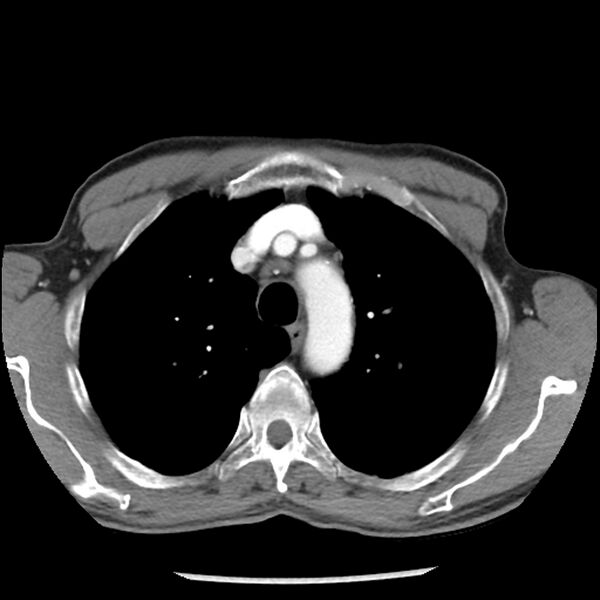 File:Adenocarcinoma of the lung - micropapillary predominant (Radiopaedia 42446-45563 Axial C+ portal venous phase 18).jpg