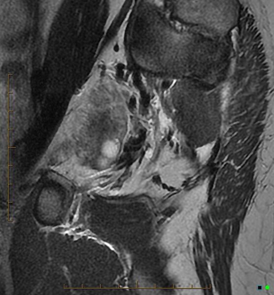 File:Adenomyosis uterus with hematometra (Radiopaedia 45779-50011 Sagittal T2 3).jpg