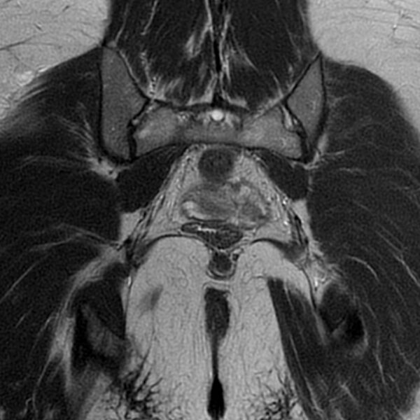 File:Adenomyosis within a septate uterus (Radiopaedia 69963-79981 Coronal T2 30).jpg