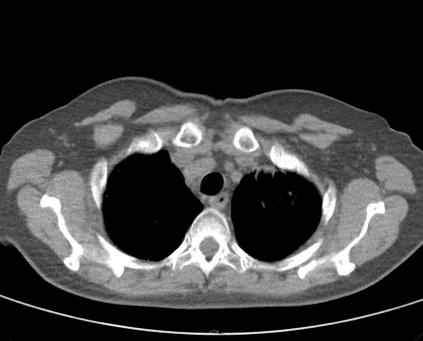 Adenosquamous lung carcinoma (Radiopaedia 22035-22030 non-contrast 17).jpg