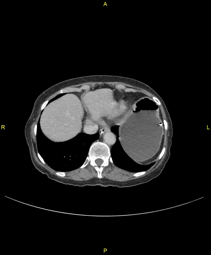 Adhesional small bowel obstruction (Radiopaedia 85402-101024 Axial C+ portal venous phase 35).jpg