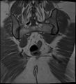 Adnexal multilocular cyst (O-RADS US 3- O-RADS MRI 3) (Radiopaedia 87426-103754 Coronal 28).jpg