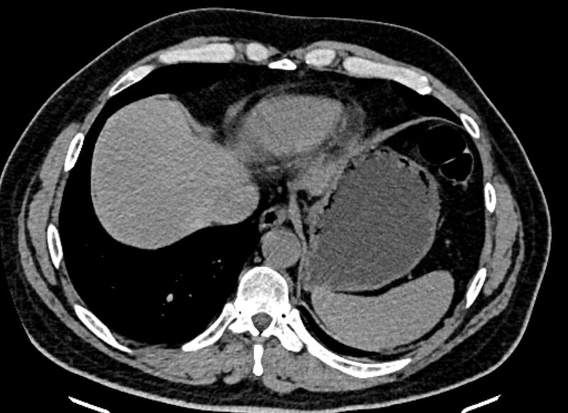 File:Adrenal metastases (Radiopaedia 73082-83791 Axial non-contrast 19).jpg