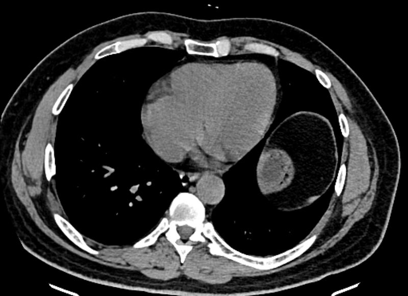 File:Adrenal metastases (Radiopaedia 73082-83791 Axial non-contrast 4).jpg