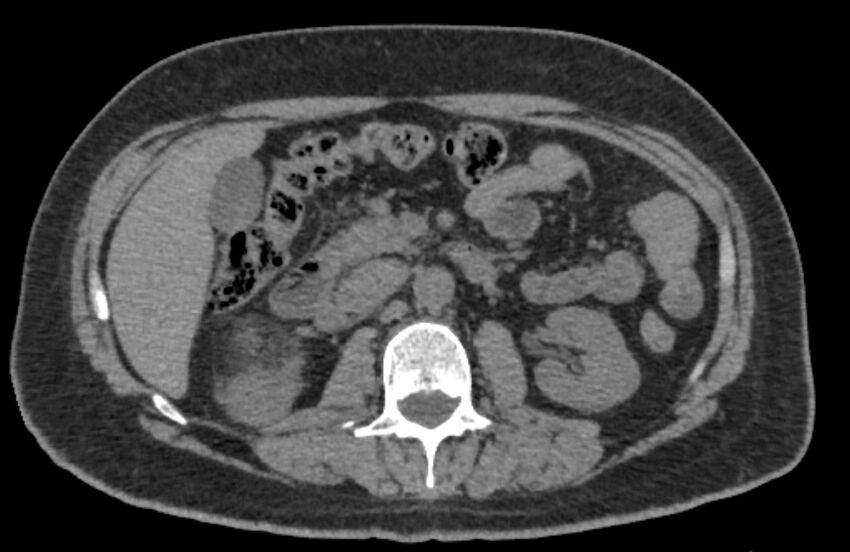 Adrenal myelolipoma (Radiopaedia 65240-74253 Axial non-contrast 59).jpg