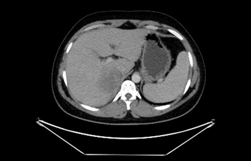 File:Adrenocortical carcinoma (Radiopaedia 80134-93438 Axial C+ portal venous phase 29).jpg