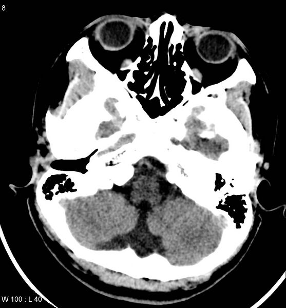 File:Aicardi syndrome (Radiopaedia 5353-7116 Axial non-contrast 5).jpg