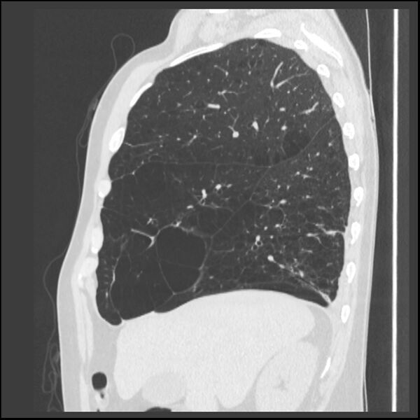 File:Alpha-1-antitrypsin deficiency (Radiopaedia 40993-43722 Sagittal lung window 201).jpg