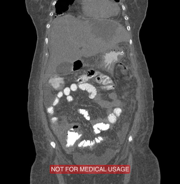 File:Amoebic enterocolitis with liver abscess (Radiopaedia 35100-36609 B 47).jpg