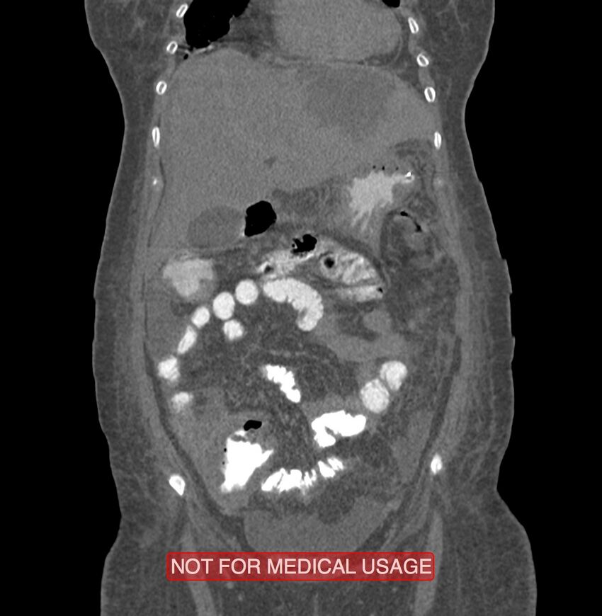 Amoebic enterocolitis with liver abscess (Radiopaedia 35100-36609 B 47).jpg