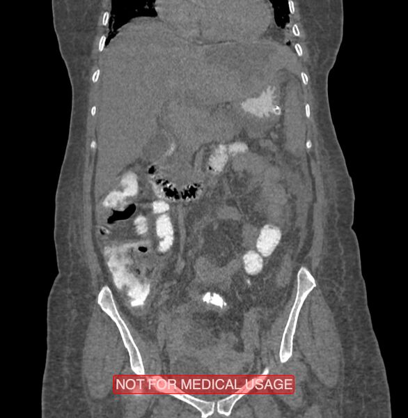 File:Amoebic enterocolitis with liver abscess (Radiopaedia 35100-36609 B 82).jpg