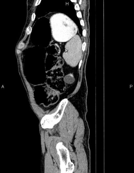File:Ampullary adenocarcinoma (Radiopaedia 86093-102032 D 85).jpg