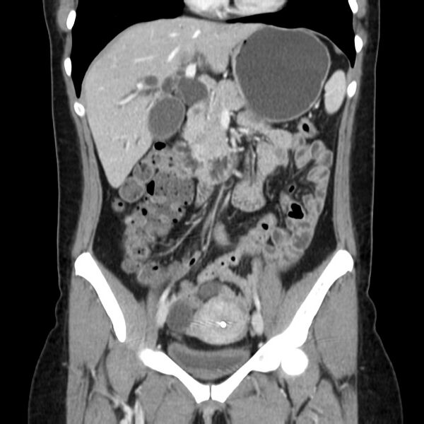 File:Ampullary tumor (Radiopaedia 22787-22816 E 25).jpg