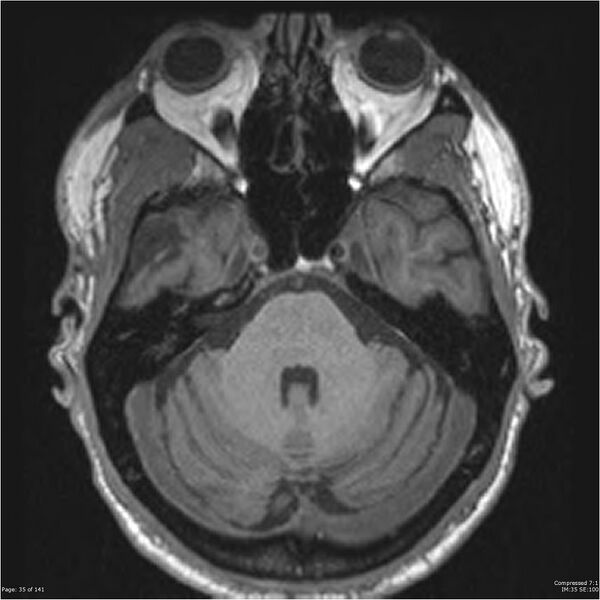 File:Anaplastic meningioma with recurrence (Radiopaedia 34452-35788 Axial T1 33).jpg