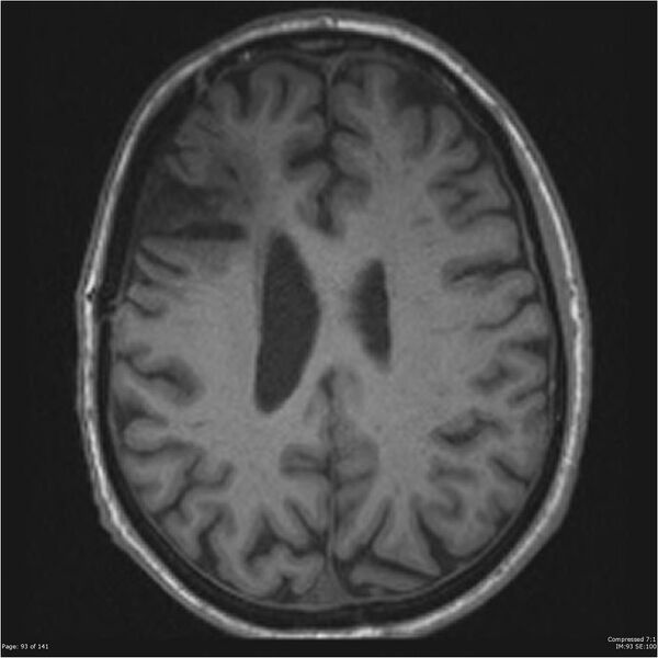 File:Anaplastic meningioma with recurrence (Radiopaedia 34452-35788 Axial T1 91).jpg