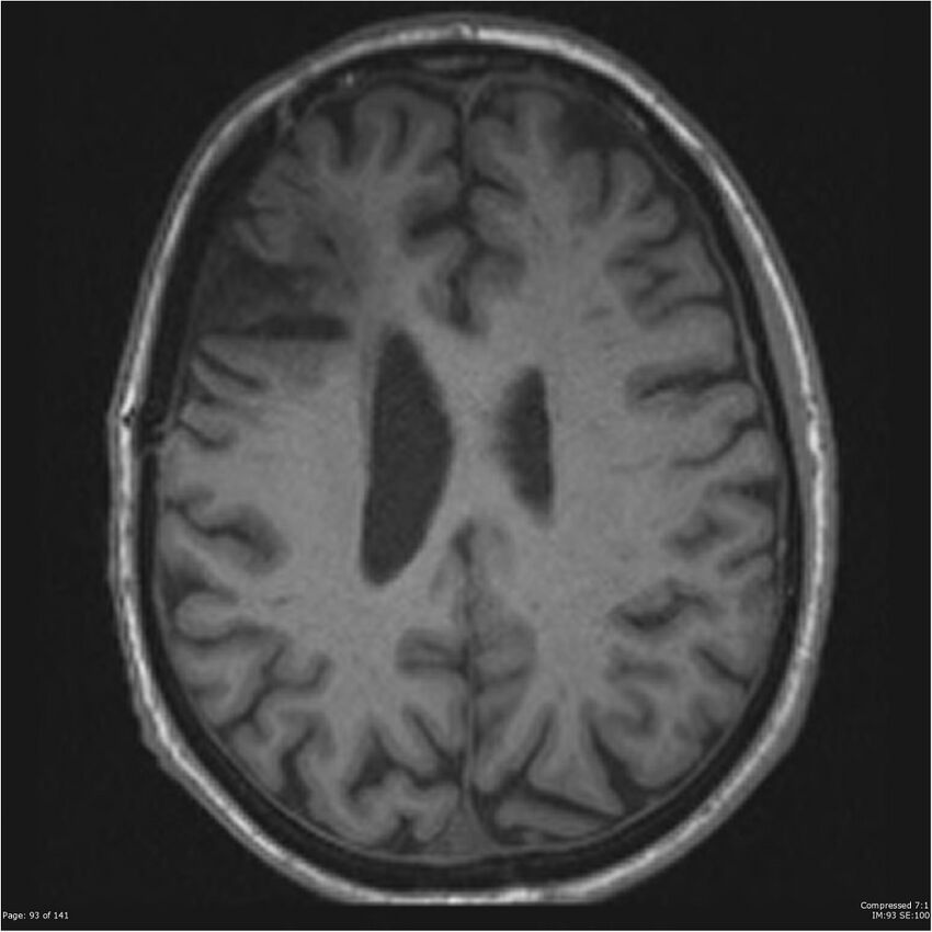 Anaplastic meningioma with recurrence (Radiopaedia 34452-35788 Axial T1 91).jpg